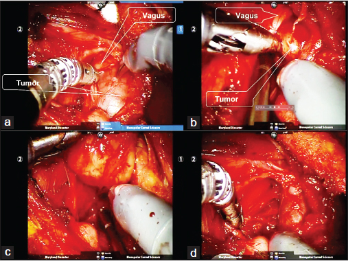 Robot-assisted excision of the neurogenic tumor via a retroauricular approach. (a) Identification of the tumor capsule and the vagus nerve. (b and c) Subcapsular dissection of the tumor. (d) Note that enucleation of the tumor was accomplished with preserving the nerve sheath of the vagus