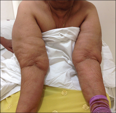 Right upper extremity lymphedema