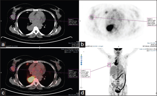 A 41-year-old woman (patient 2 in Table 1) with right breast fibroadenoma was being evaluated for carcinoma of the lung. (a) Computed tomography portion of fluorodeoxyglucose positron emission tomography/computed tomography shows a soft tissue lesion (measures 3.0 cm × 1.6 cm) in the outer quadrant with well-defined margins. (b) Axial positron emission tomography image shows focal area of increased metabolism (maximum standardized uptake value = 2.3) in the right breast, outer quadrant. (c) Positron emission tomography/computed tomography fused image and (d) positron emission tomography-maximum intensity projection image