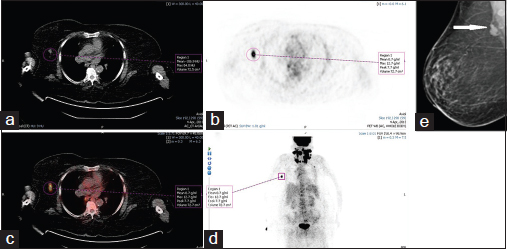 A 74-year-old woman (patient 6 in Table 1) with non-Hodgkin's lymphoma breast was being evaluated for non-Hodgkin's lymphoma of head and neck region. (a) Computed tomography portion of fluorodeoxyglucose positron emission tomography/computed tomography shows a soft tissue lesion (measuring 0.8 cm) with regular margins. (b) Axial positron emission tomography image shows a hypermetabolic soft tissue nodule in right breast lower outer quadrant (maximum standardized uptake value = 12.7). (c) Fused positron emission tomography/computed tomography images and (d) positron emission tomography-maximum intensity projection image. (e) Mammogram shows heterogeneously dense breast parenchyma with axillary lymph nodes (arrow)