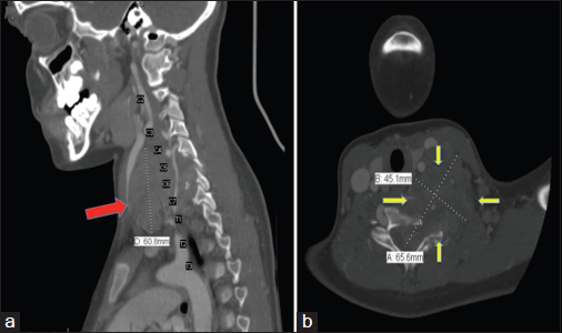 Computed tomography neck with contrast of Case 1. (a) (Left): Sagittal section showing a heterogeneous infrahyoid neck mass (red arrow) extending from the level of C4 to T1 junction in the supraclavicular region located deep to the sternocleidomastoid muscle and posterior and lateral to the carotid sheath. (b) (Right): Axial section at the level C6-C7 showing an infrahyoid mass (yellow arrows) eroding into the vertebrae. The mass is in direct contact with the upper esophagus, left thyroid lobe, left internal jugular vein, and left common carotid artery