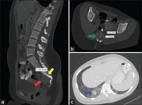 Computed tomography lumbosacral spine and chest with the contrast of Case 2. (a) (Left): Sagittal section is showing enlarged mesenteric lymph nodes and a 4.3 cm × 3.9 cm × 5.0 cm soft tissue mass (red arrow), inseparable from the lower sacrum and coccyx extending into the spinal canal with sclerosis in the adjacent bones (yellow arrow), (b) (Right upper): Axial section of the sacral mass at the sacrococcygeal level (green arrow), (c) (Right lower): Axial section soft tissue window of the lung showing right lower lobe pulmonary nodule (blue arrow) suggestive of pulmonary metastasis surrounded by ground glass opacity