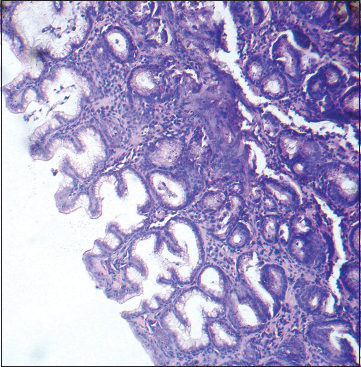 Gastric serrated adenoma showing serrated epithelium with scalloped margins with subepithelial glands showing focal hyperchromasia (H and E, staining ×400)