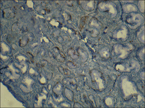 Ki-67 immunohistochemistry showing positivity of subepithelial glands and intermittent positivity of serrated epithelium (Ki-67 ×100)