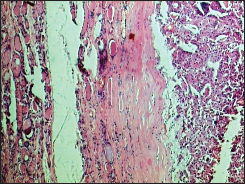 Scanner view to show thyroid with an encapsulated tumor with follicular pattern showing follicles of varying size (H and E, ×10)