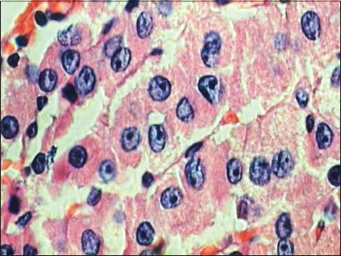 High-power view showing nuclear details of follicular cells with prominent nuclear grooves (H and E, ×40)