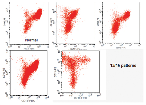 Abnormal patterns in CD13 versus CD16 plots. Normal controls show an inverted “nike” pattern. Myelodysplastic syndrome graphs reveal different variations compared with normal graphs