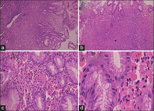 (a) Diffuse sheets of lymphocytes in lamina propria (H and E, ×10). (b) Diffuse sheets of lymphocytes admixed with plasma cells (H and E, ×10). (c) Numerous Mott cells in superficial lamina (H and E, ×40). (d) Numerous Mott cells with itracytoplasmic eosinophilic inclusion (H and E, ×100)