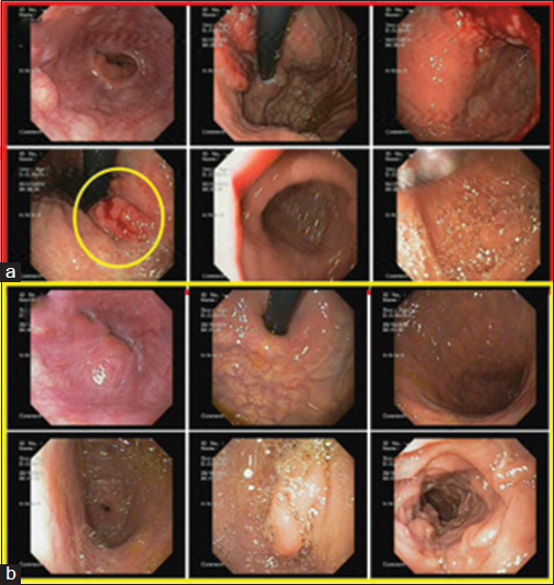 (a) Upper gastrointestinal endoscopy showing mass in fundus and cardia. (b) Follow-up upper gastrointestinal endoscopy showing no residual mass