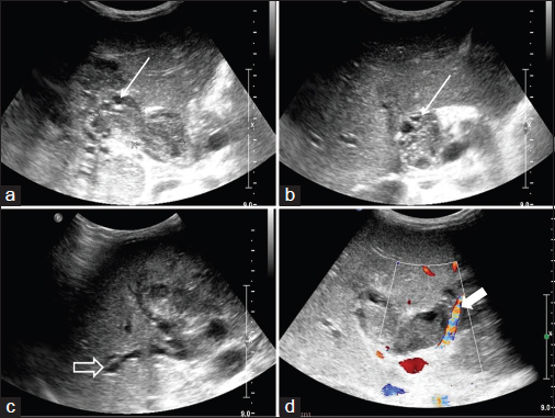 (a-c) Ultrasonography of the patient shows a solid echogenic lesion with multiple cystic areas within (straight arrow) filling up the lumen of common bile duct. Note the intrahepatic biliary dilatation (hollow arrow) resultant to biliary obstruction caused by the tumor. The color Doppler examination (d) reveals a prominent vessel running along and supplying the tumor (solid arrow). This was separate from the common hepatic artery (not shown here)