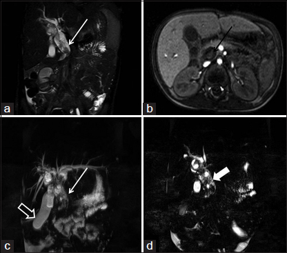 (a) T2-weighted image fat suppressed coronal image showing the “bubbly appearance” (isointense tumor interspersed with hyperintense cystic areas) typical for botryoid-rhabdomyosarcoma (white arrow). (b) The contrast enhanced axial scan shows heterogeneous lesion with cystic and enhancing solid areas. The solid area shows the internal area of “ring enhancement” located in the tumor (black arrow). (c and d) The magnetic resonance cholangiopancreatography images show intrahepatic biliary dilatation with a distended gall bladder (hollow arrow). Note the “bubbly appearance” is better seen on the thin section magnetic resonance cholangiopancreatography images (solid arrow in d)