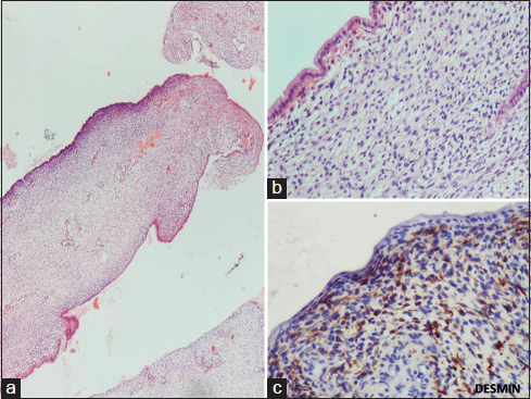 (a) Tumor showed polypoid nodules, with an abundant, loose, myxoid stroma embedded in which are present small undifferentiated cells and showing distinctive hypercellular zone (cambium layer) just below the columnar mucosal epithelium (H and E, ×40). (b) High power view showed round to oval-, spindle-, and stellate-shaped primitive mesenchymal cells embedded in a loose myxoid matrix present (H and E, ×400). (c) Several tumor cells show immunoreactivity for desmin (Desmin, ×400)