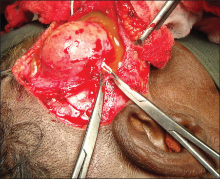 Exposure of the lesion within temporalis muscle with fluid coming out due to accidental puncture of the lesion