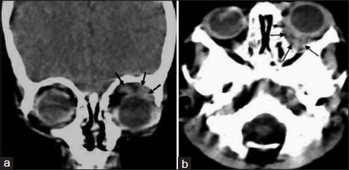 Computed tomography head showing two lobulated soft tissue density lesions in left orbit. (a) Chloroma, 2 cm × 0.8 cm, involving left lacrimal gland in superior peri-orbital space of with extension into upper eyelid. (b) Second lesion, 2.4 cm × 0.9 cm, in retro–orbital space of same side