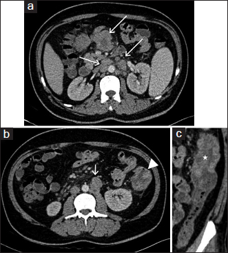 Axial contrast-enhanced computed tomography images (a and b) show multiple enlarged heterogeneously enhancing lymph nodes in mesentery and retroperitoneum (arrows). (b) Depicts nodular wall thickening in the region of proximal descending colon (arrowhead). (c) Oblique coronal multiplanar reformat image better shows the nodular wall thickening in the proximal descending colon (asterisk). Note is made of mild pericolonic fat stranding