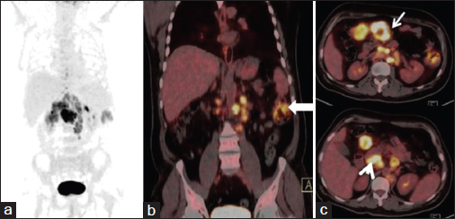 (a) Maximum intensity projection image (b) coronal fused positron emission tomography-computed tomography and (c) transaxial fused positron emission tomography-computed tomography images reveal abnormal tracer accumulation in the descending colon (thick arrow) and multiple enlarged nodes in the mesentry (thin arrow) and peripancreatic (arrowhead) locations showing avid 18F 2-fluoro-2-deoxy-d-glucose uptake