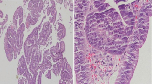 Colonic biopsy