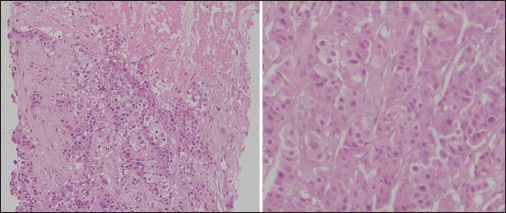 Mesenteric lymph node biopsy