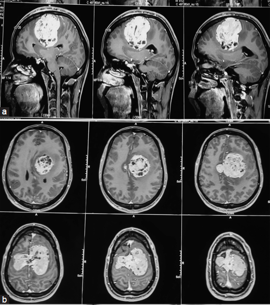 (a) Preoperative T1-weighted image is showing postcontrast enhancement of an extra-axial mass in frontoparietal lobe: Saggital section. (b) Preoperative T1-weighted image showing postcontrast enhancement of an extra-axial mass in frontoparietal lobe: Axial section