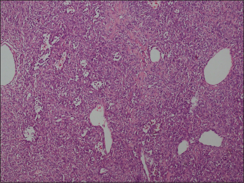 Low power photomicrograph showing moderately cellular tumor with many hemangiopericytomas and branching vascular channels (H and E, ×2)