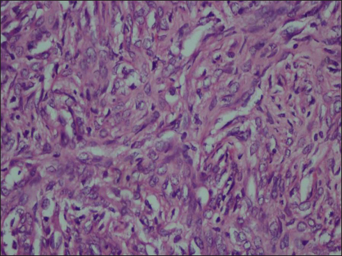 Tumor cells seen as oval to spindle shaped cells with monomorphic nuclei (H and E, ×20)