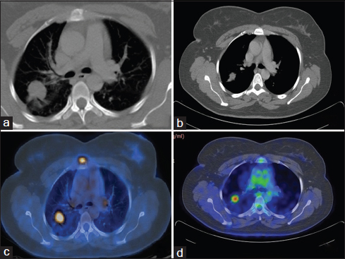 (a and b) Baseline positron emission tomography/computerized tomography showing right upper lobe lesion (27 mm × 22 mm, standardized uptake value 11.2), mediastinal and hilar lymph nodes (standardized uptake value 7.6). (c and d) Reassessment positron emission tomography/computerized tomography after #4 showing right upper lobe lesion (16 mm × 14 mm, standardized uptake value 5.9), mediastinal and hilar lymph nodes not significant by size criteria
