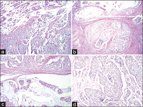 (a) section showing areas of large cell neuroendocrine carcinoma (H and E, ×200). (b-d) section showing a collision tumor comprising enteric-type adenocarcinoma and large cell neuroendocrine carcinoma of urinary bladder (H and E, ×100)