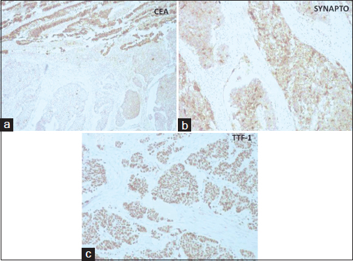 (a) section showing synaptophysin positivity in large cell neuroendocrine carcinoma areas (DAB, ×100). (b) section showing thyroid transcription factor-1 positivity in large cell neuroendocrine carcinoma areas (DAB, ×100). (c) section showing carcinoembryonic antigen positivity in areas of enteric type adenocarcinoma (DAB, ×100)