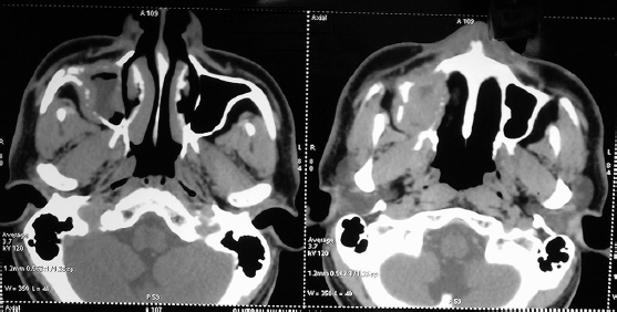 Axial images of contrast-enhanced computed tomography of face showing soft-tissue lesion in right maxilla with bony destruction