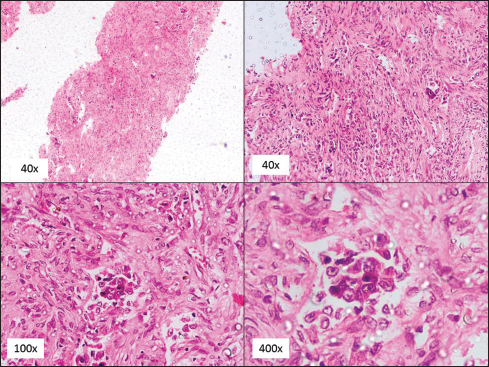 Spindle cell proliferation with few islands of atypical epithelial cells with ductal/glandular formation