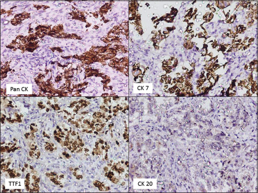 Tumor cells positive for thyroid transcription factor-1 and cytokeratin 7 and negative for cluster of differentiation 99, cytokeratin 20, and vimentin