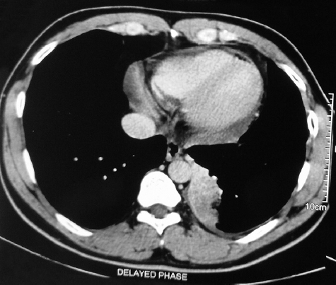 Well-defined heterogeneously enhancing mass in posterobasal segment of left lower lobe around 5.2 cm × 3.9 cm × 7.5 cm in size with mild pleural effusion