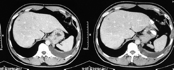 Multiple ill-defined poorly delineated space-occupying lesions involving all segments of liver