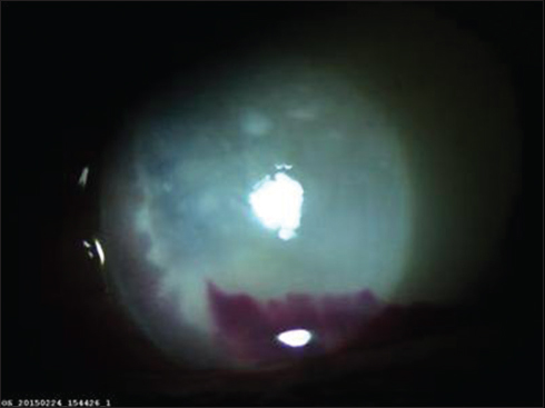 Slit-lamp photograph left eye showing whitish exudates (pseudohypopyon) covering whole of the anterior chamber except some portion of the iris