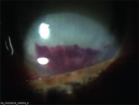 Slit-lamp photograph left eye showing deep vascularization in the inferior quadrant along with hyphema and full chamber pseudohypopyon