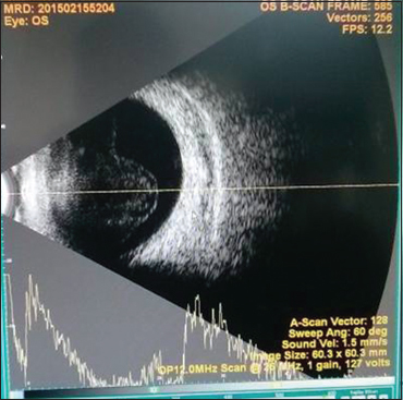 B-scan left eye showing hyperechoic shadows of 40%–50% reflectivity suggestive of exudates in vitreous and posterior vitreous detachment