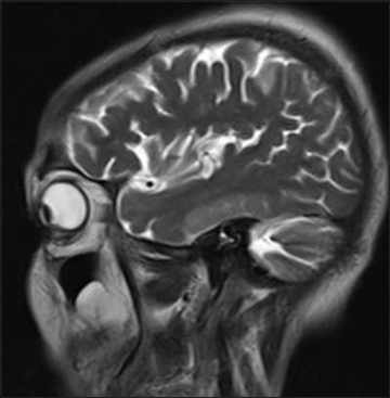 Magnetic resonance imaging T2-weighted sagittal image showing thickening of uveal tissue more marked in the anterior portion of the uvea