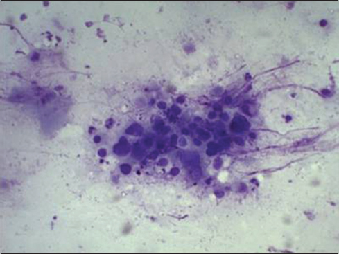 Cytology of aqueous tap showing features of squamous cell carcinoma