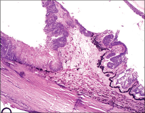 Squamous cell carcinoma infiltrating ciliary processes