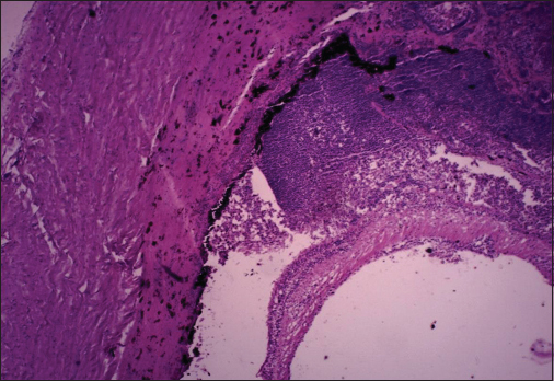 Histopathological examination of the eye showing squamous cell carcinoma invading subretinal space between choroid and retina