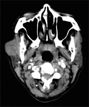 Computerized tomography head: A well-defined moderately enhancing lesion involving the superficial right parotid gland and abutting the masseter muscle with loss of fat planes between the two