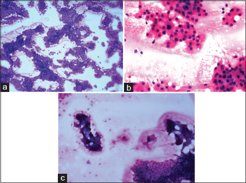 Fine-needle aspiration biopsy smears: (a) showing high cellularity and arborizing papillary structures (H and E, ×100), (b) showing the cell morphology resembling oncocytes and the acinar arrangement (H and E, ×400), (c) showing the secretions resembling thick colloid in background (H and E, ×100)