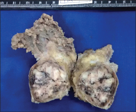 Gross photograph: A capsulated tumor having a gray-white and hemorrhagic cut surface