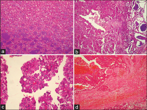 Histopathology of the tumor: (a) microcystic pattern (H and E, ×100), (b) papillary structures (H and E, ×100), with (c) lining of columnar cells having moderate amount of eosinophilic cytoplasm and vesicular nuclei, few with single nucleoli (H and E, ×400) and (d) thick fibrous capsule between the tumor and normal salivary gland which is breached by the infiltrating tumor cells (H and E, ×100)