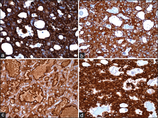 Immunoreactivity for (a) CK7, (b) CK19, (c) EMA, and (d) vimentin (×400)