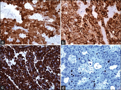 Immunoreactivity for (a) S100, (b) HMW-CK, (c) Her2, and (d) Ki67 (×400)