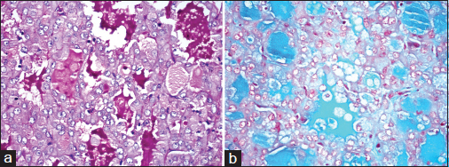 Special stains: (a) PAS-positive and (b) alcian blue-positive luminal secretions (×400)