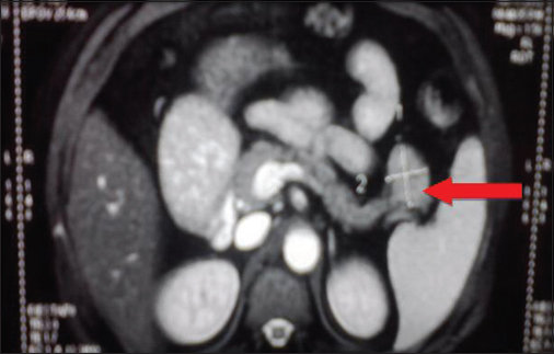 Contrast-enhanced magnetic resonance imaging abdomen: Well defined round to oval exophytic mass lesion of size 3 cm × 3 cm × 2.7 cm arising from tail and distal body of pancreas suggesting the possibility of pancreatic neuroendocrine tumor