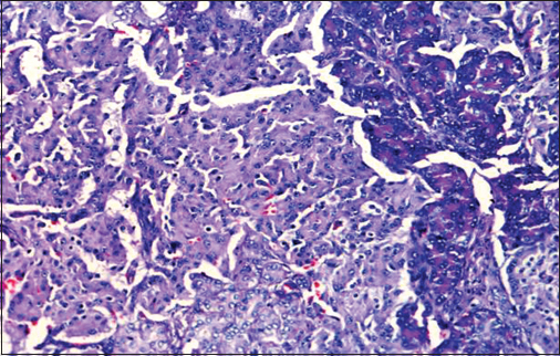 Histopathological examination of insulinoma: Shows sheets of uniform round cells with moderate cytoplasm and arranged in a trabecular pattern. Nuclei showing granular chromatin. Intervening stroma is fibrovascular and shows congested sinusoidal vascular spaces. Mitotic activity is minimal <10/10 HPF