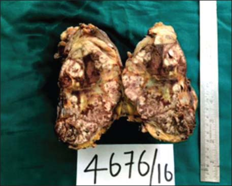 Mastectomy specimen showing huge lobulated tumor occupying almost the entire breast parenchyma